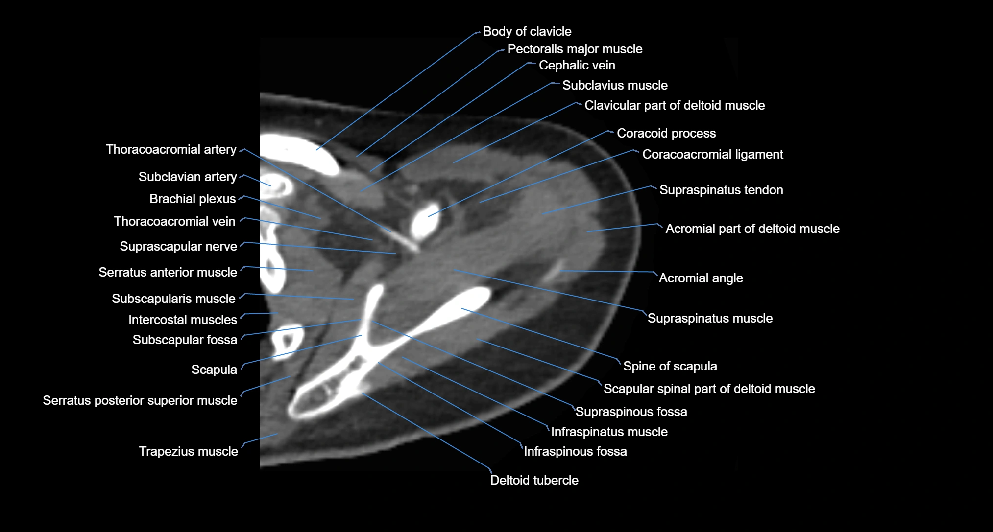 CT Shoulder axial cross sectional anatomy labelled radiology image -00021.webp
